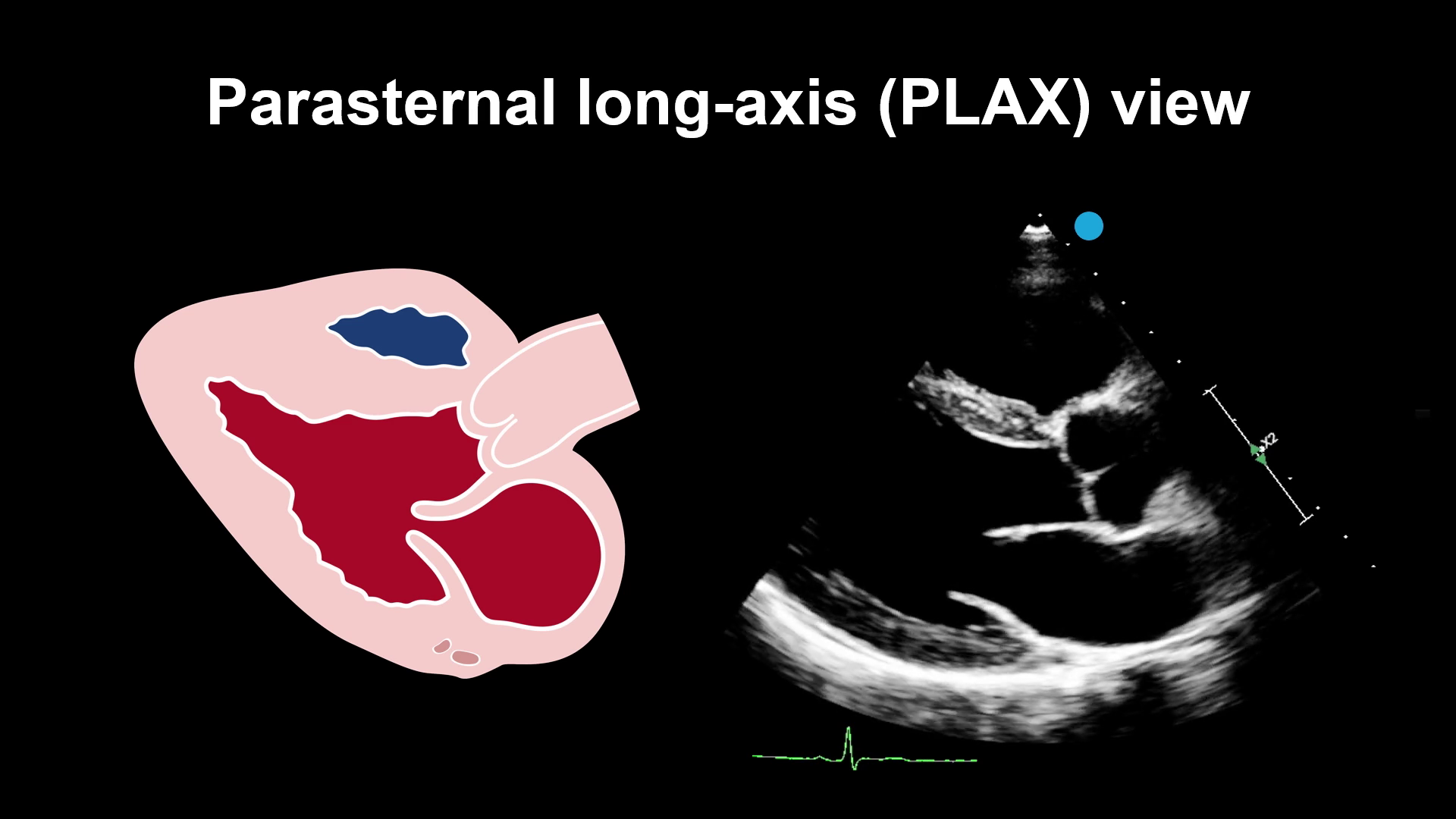 The Right Heart in Ultrasound